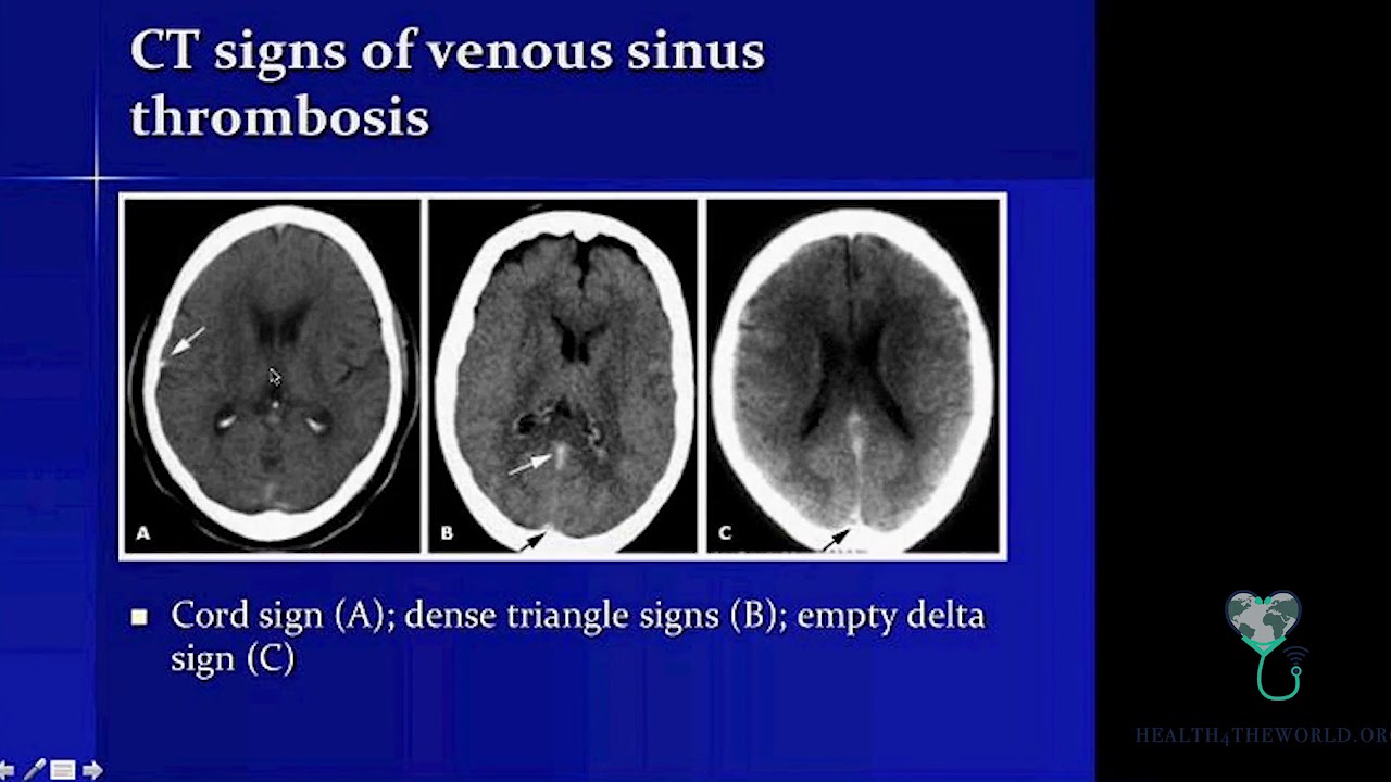 Cerebral venous thrombosis